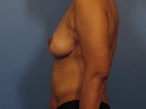 After Major Weight Loss Patient Photo - Case 325 - after view-2