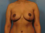 Breast Asymmetry - Case 1023 - After