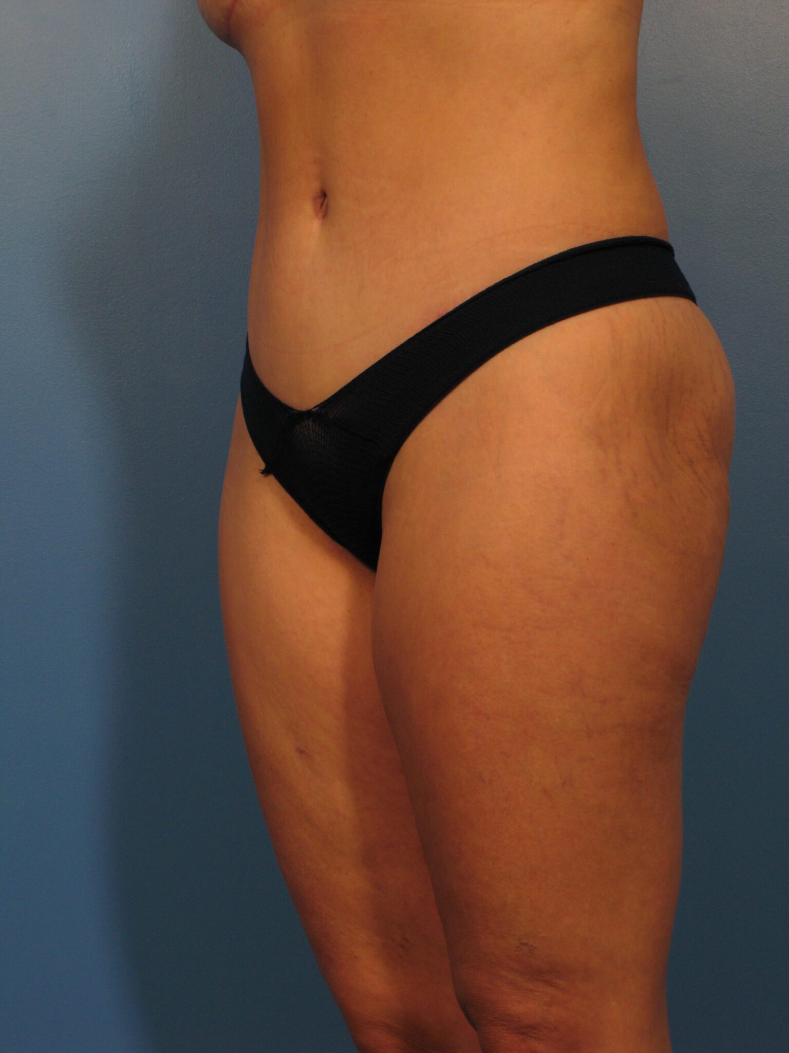 Tummy Tuck Patient Photo - Case 1025 - after view-1