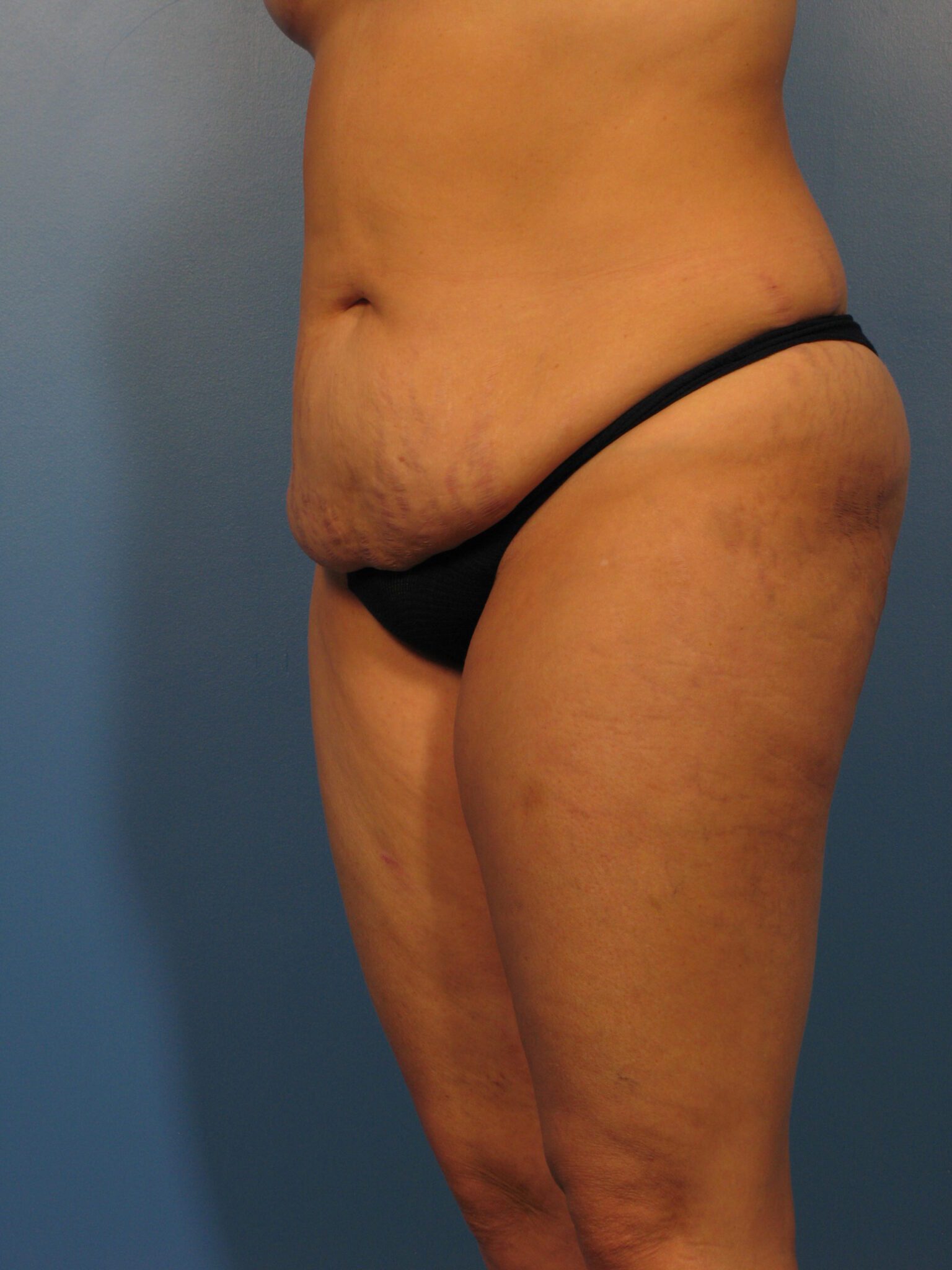 Tummy Tuck Patient Photo - Case 1025 - before view-1