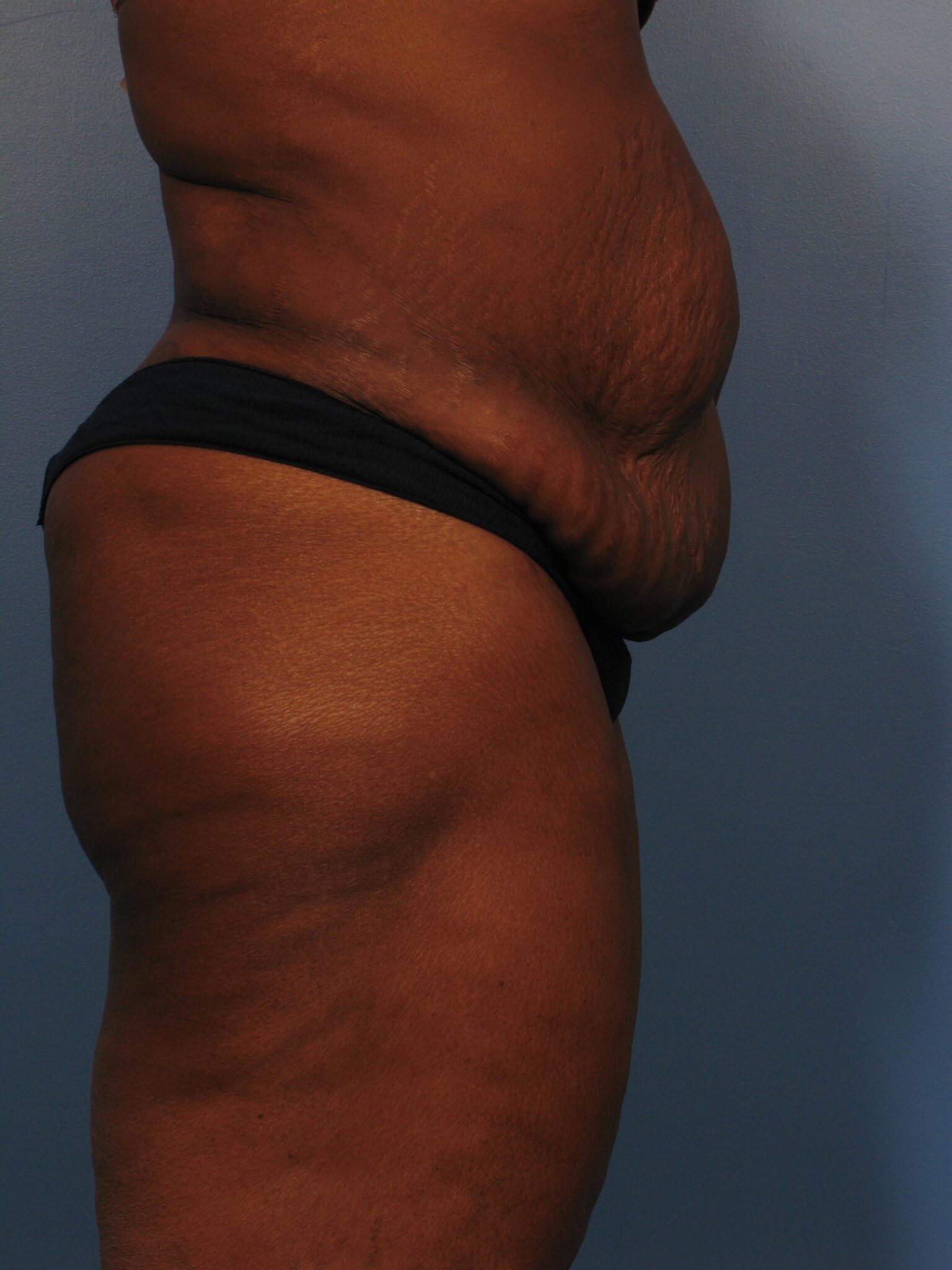 Tummy Tuck Patient Photo - Case 1026 - before view-1