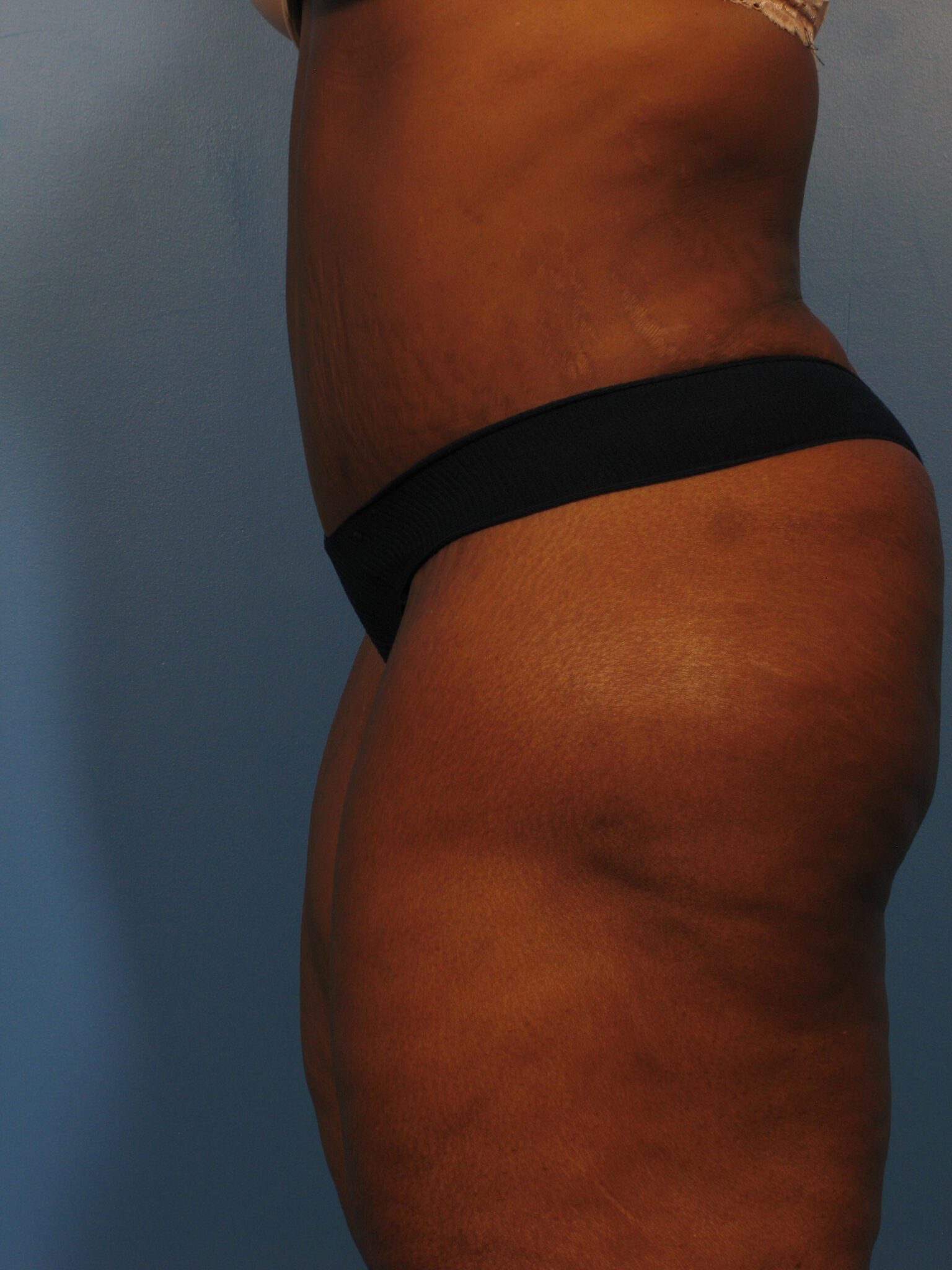 Tummy Tuck Patient Photo - Case 1026 - after view-2