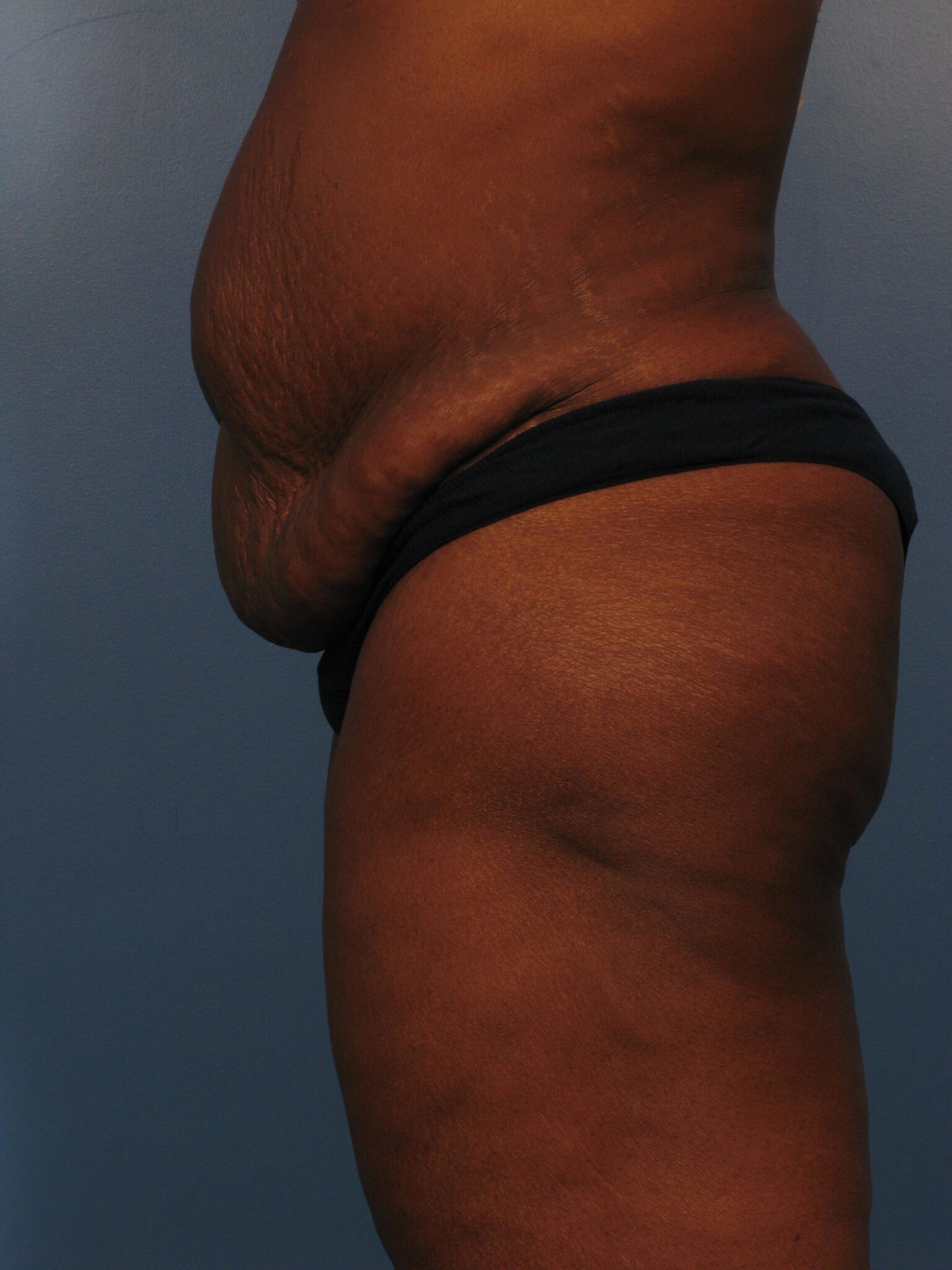 Tummy Tuck Patient Photo - Case 1026 - before view-2