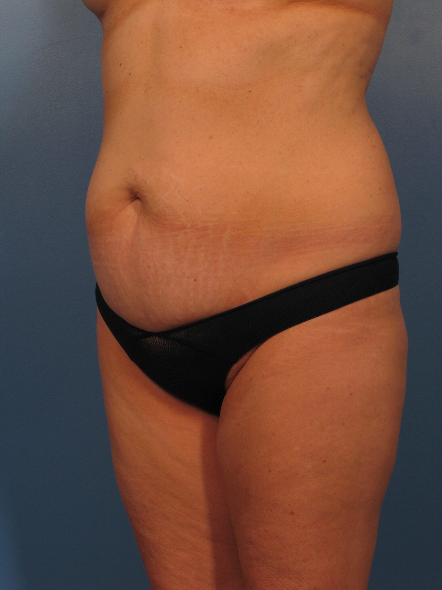 Tummy Tuck Patient Photo - Case 1029 - before view-1