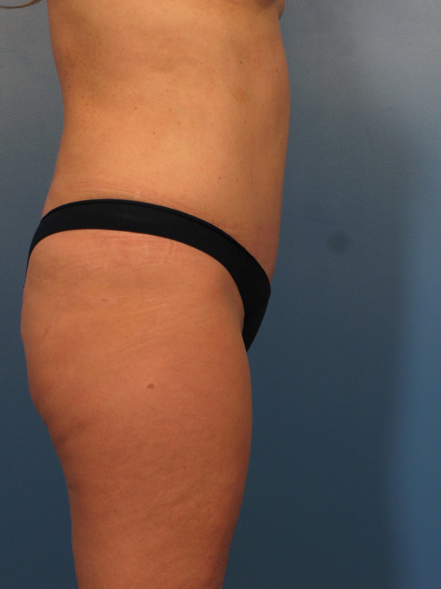 Tummy Tuck Patient Photo - Case 1029 - after view-2