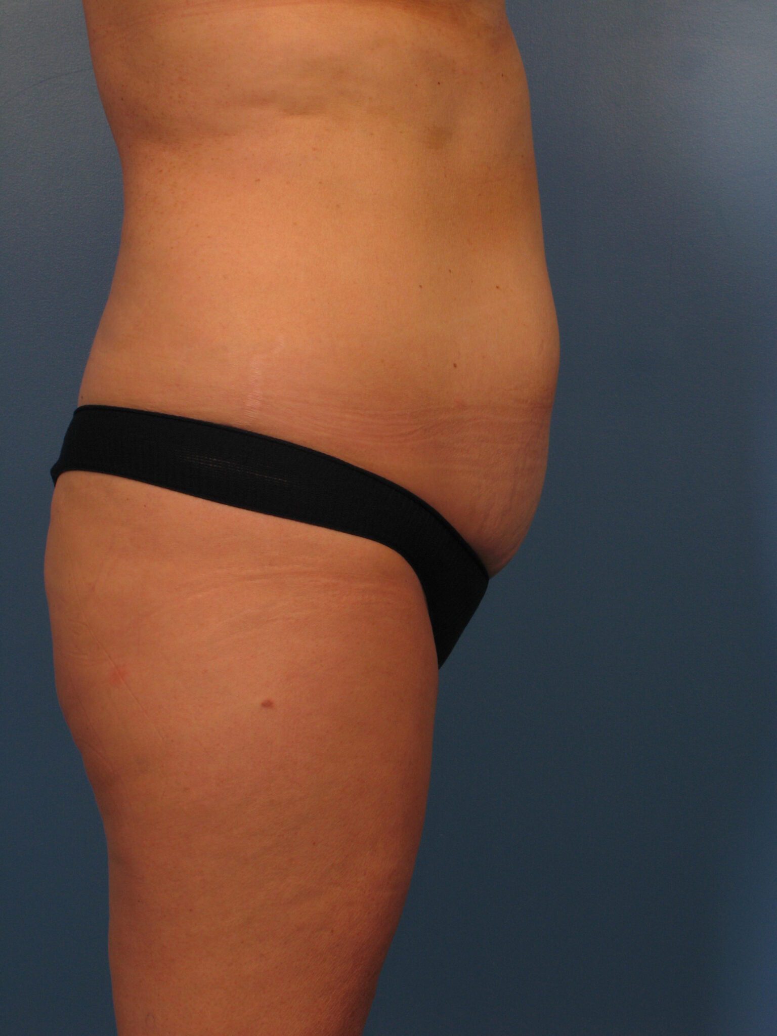 Tummy Tuck Patient Photo - Case 1029 - before view-2