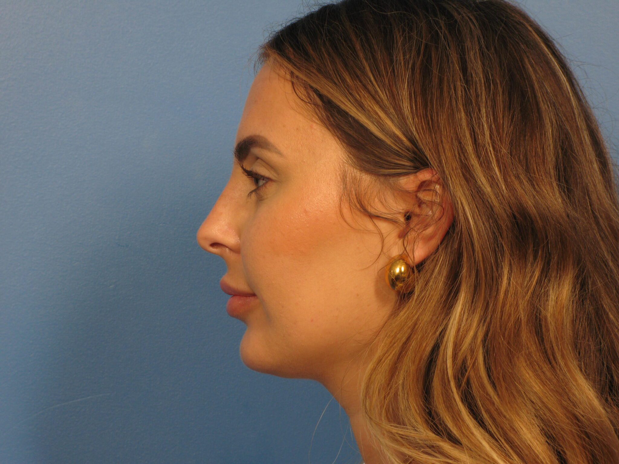 Chin Contouring Patient Photo - Case 1009 - after view-1