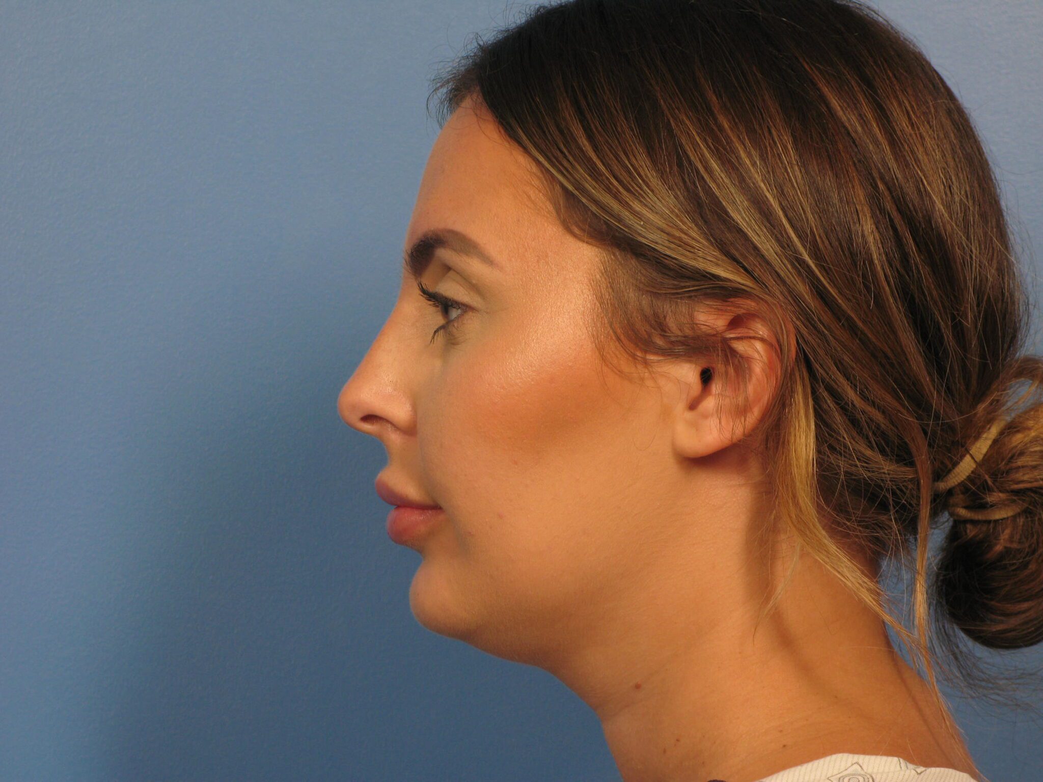 Chin Contouring Patient Photo - Case 1009 - before view-1