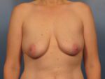 Breast Augmentation with Lift - Case 1008 - Before