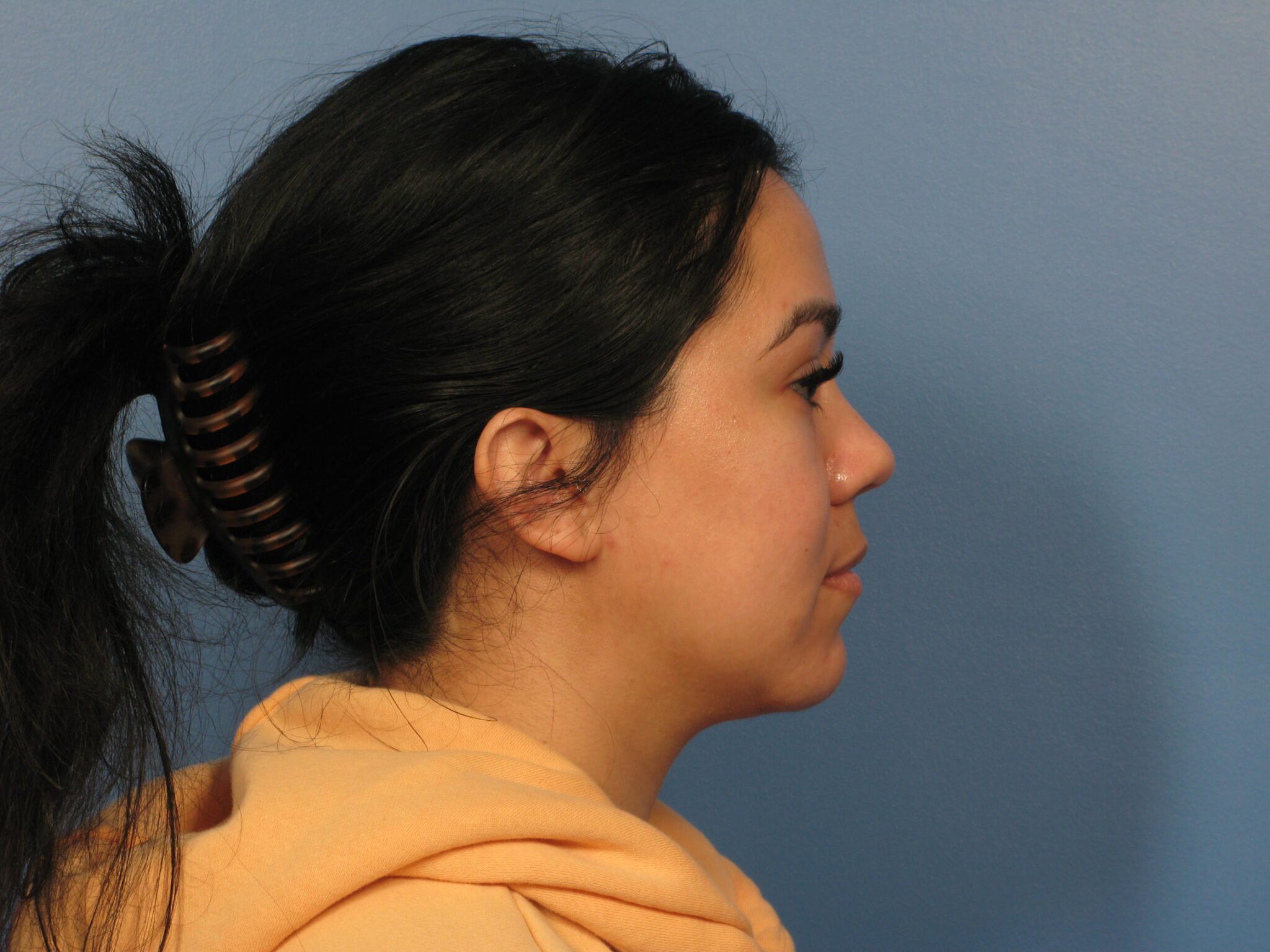 Chin Contouring Patient Photo - Case 1010 - after view-1