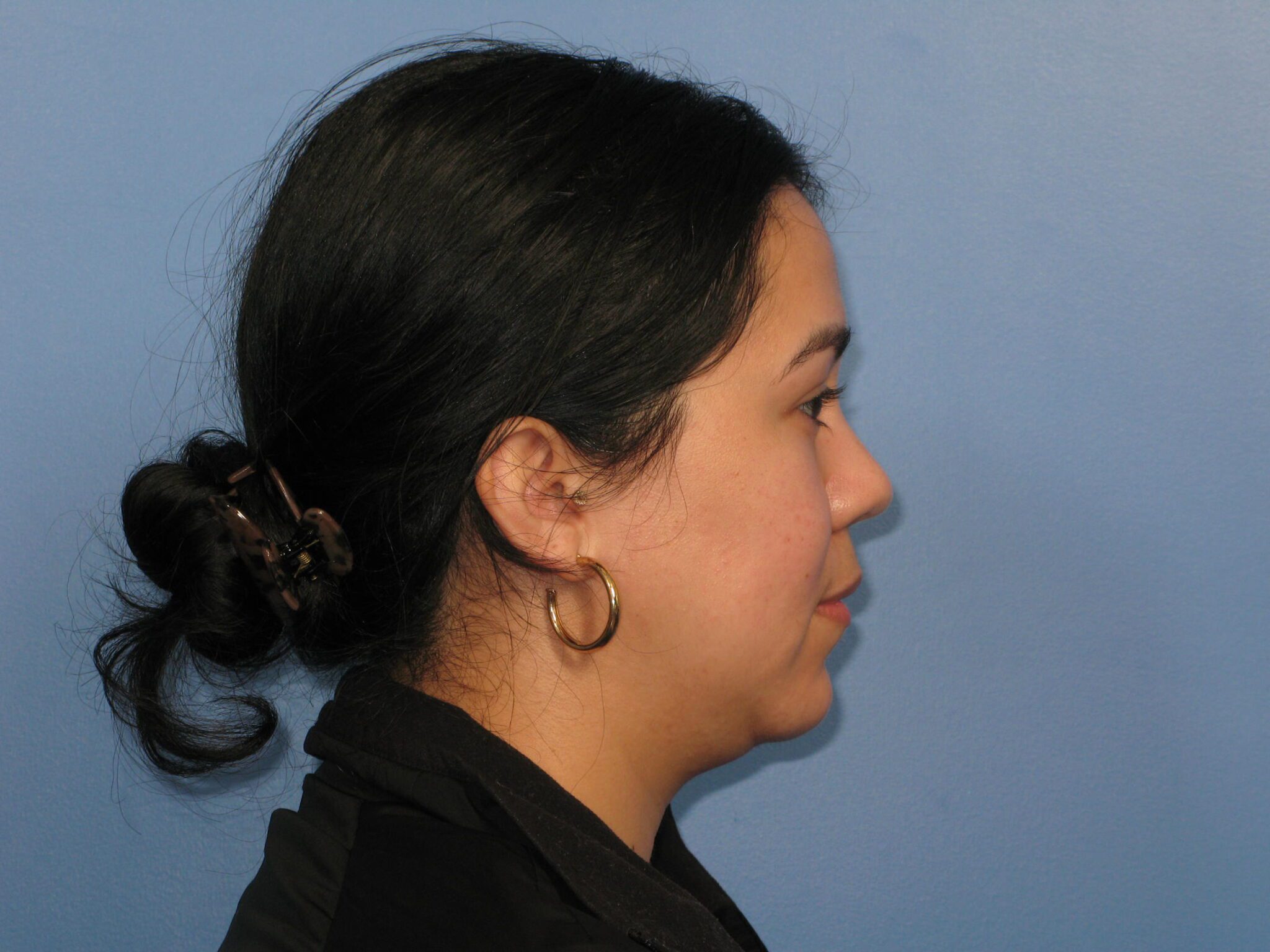 Chin Contouring Patient Photo - Case 1010 - before view-1