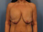 Breast Augmentation with Lift - Case 1012 - Before