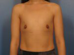 Breast Augmentation - Case 1015 - Before