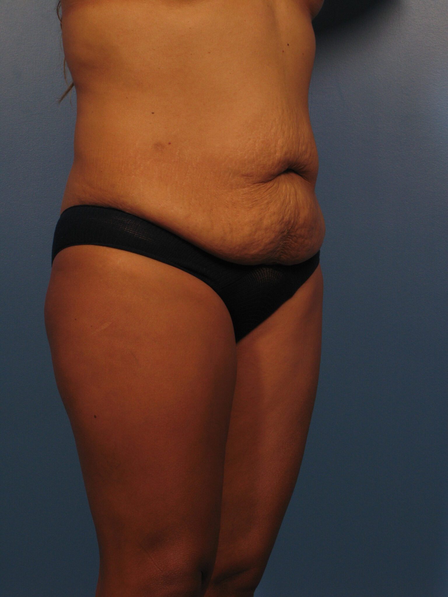 Tummy Tuck Patient Photo - Case 1019 - before view-2