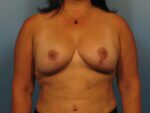 Breast Lift - Case 1034 - After