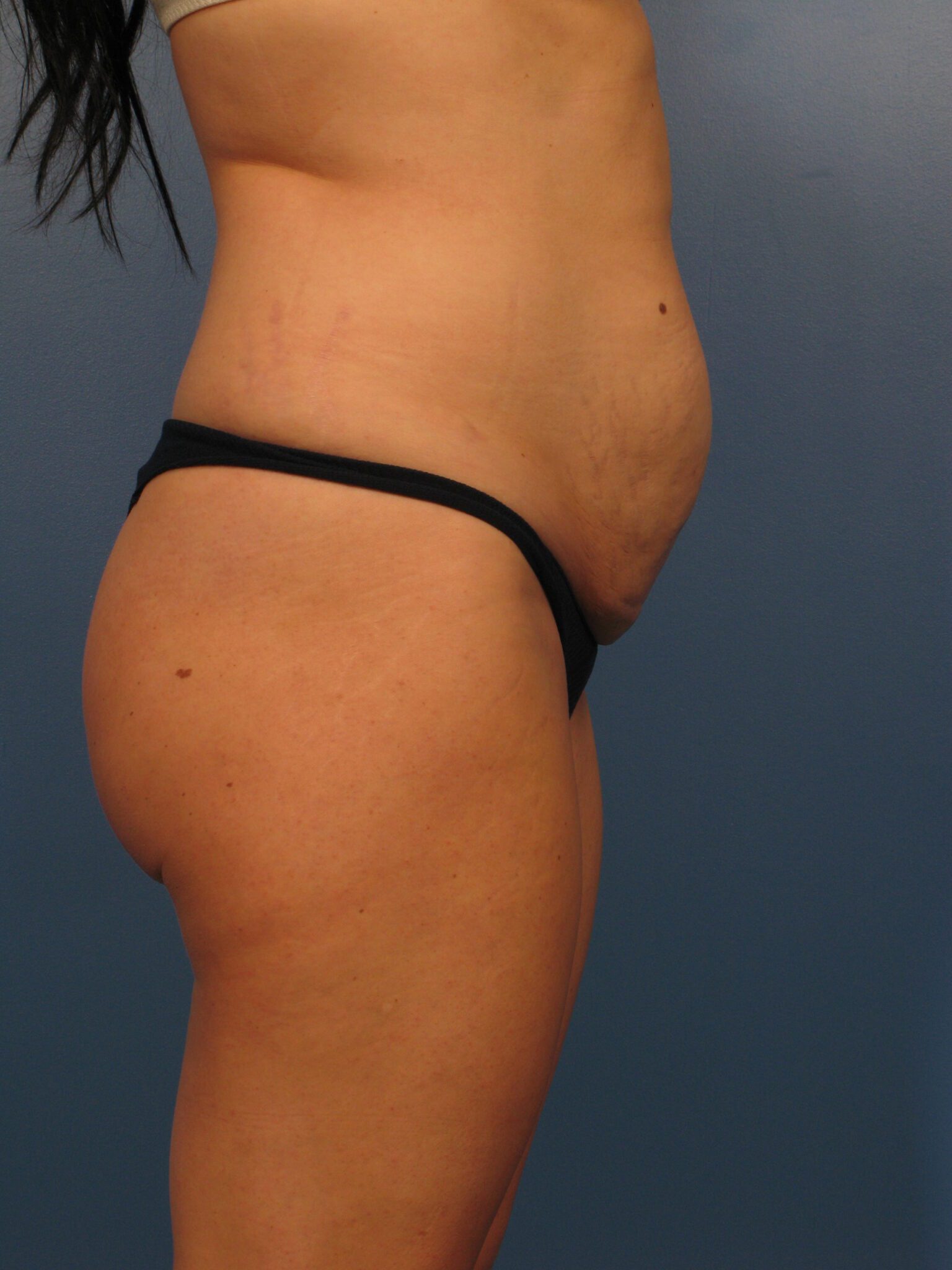 Tummy Tuck Patient Photo - Case 1037 - before view-2