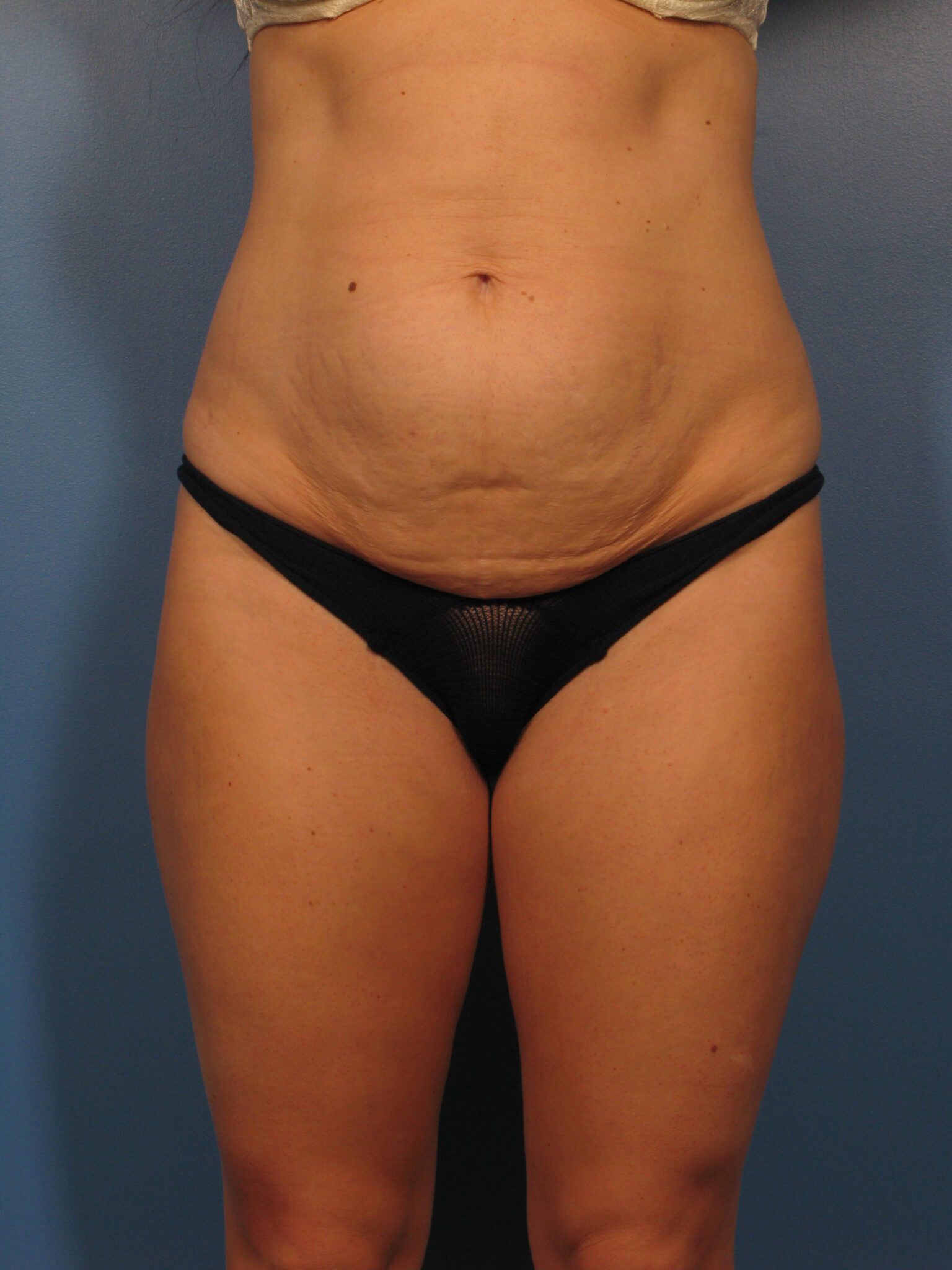 Tummy Tuck Patient Photo - Case 1037 - before view-1