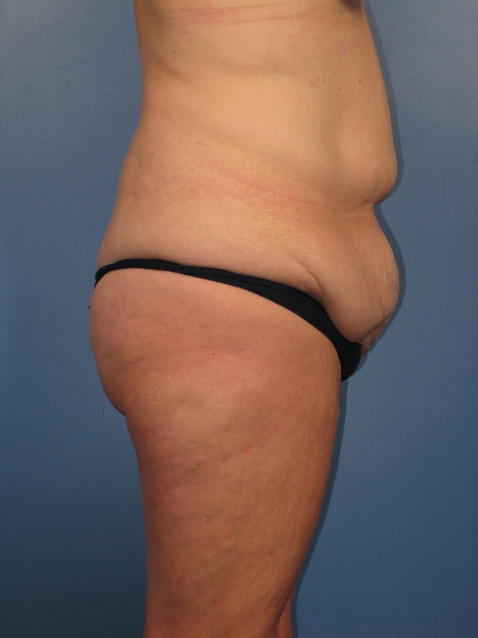 After Major Weight Loss Patient Photo - Case 1047a - before view-2