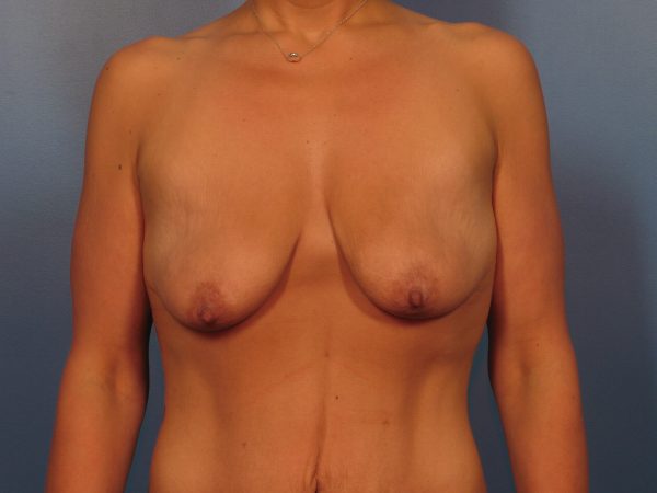 Breast Augmentation with Lift Patient Photo - Case 1042a - before view-1