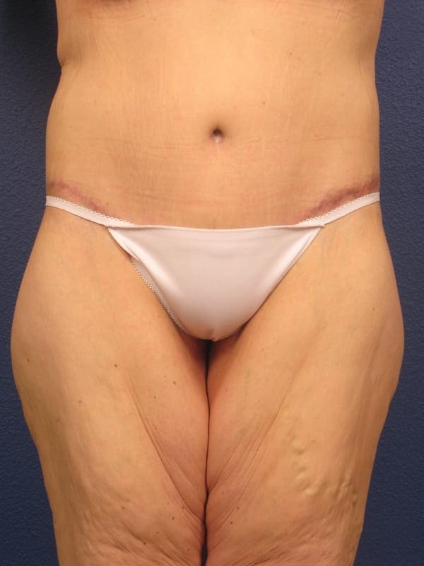 After Major Weight Loss Patient Photo - Case 179 - after view-5