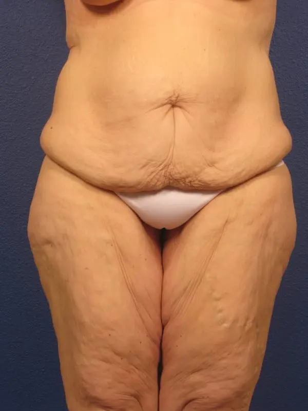 After Major Weight Loss Patient Photo - Case 179 - before view-5