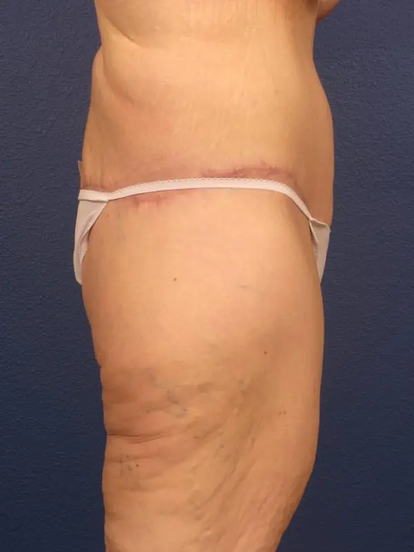 After Major Weight Loss Patient Photo - Case 179 - after view-4