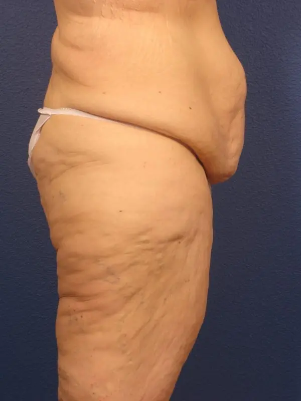 After Major Weight Loss Patient Photo - Case 179 - before view-4