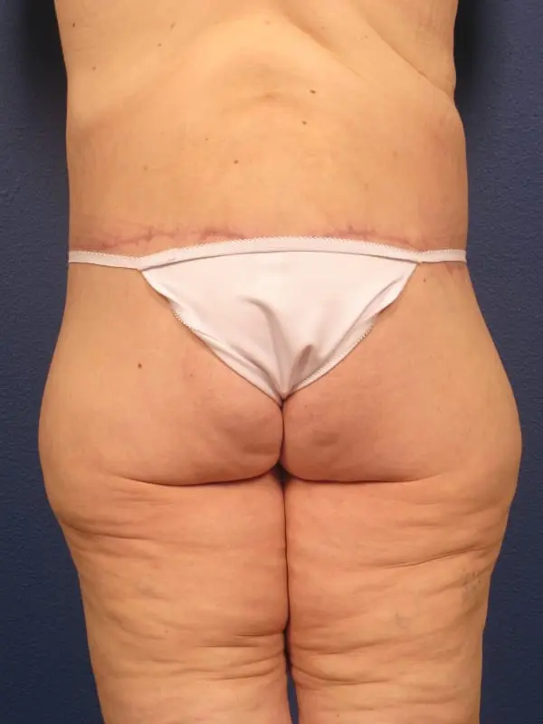 After Major Weight Loss Patient Photo - Case 179 - after view-3