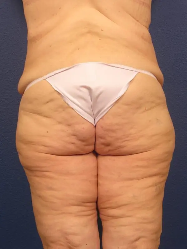 After Major Weight Loss Patient Photo - Case 179 - before view-3