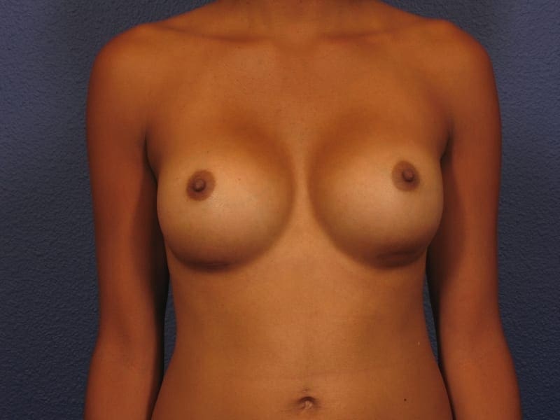 Breast Augmentation Patient Photo - Case 209 - after view-2