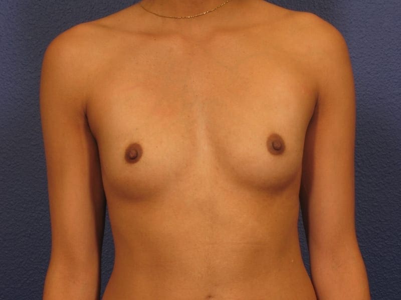 Breast Augmentation Patient Photo - Case 209 - before view-2