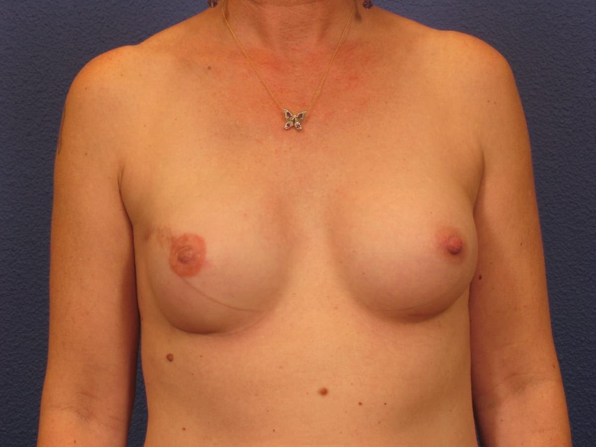 Breast Reconstruction Patient Photo - Case 242 - after view-2