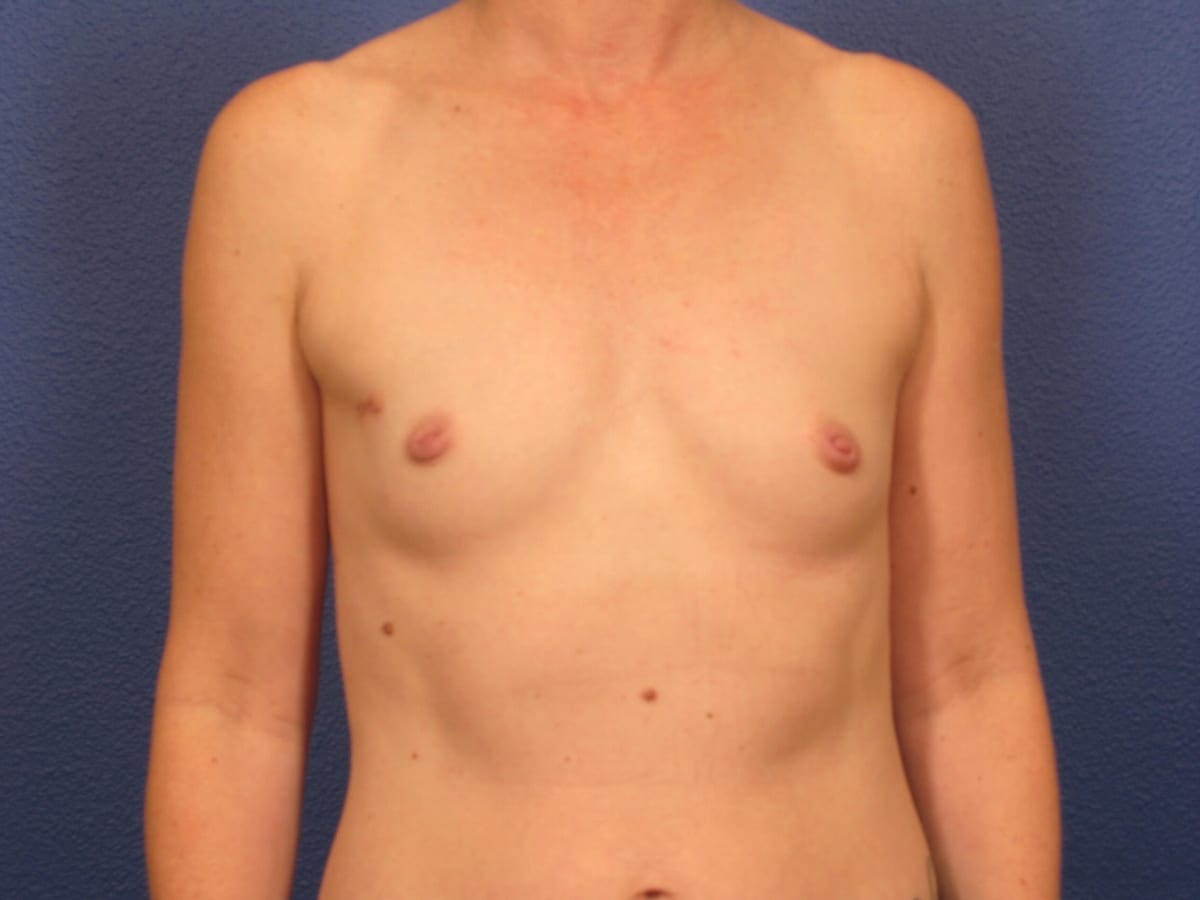 Breast Reconstruction Patient Photo - Case 242 - before view-2