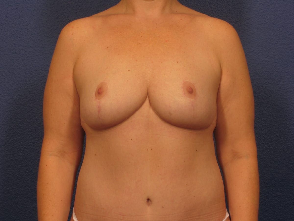 Breast Reduction Patient Photo - Case 247 - after view-2