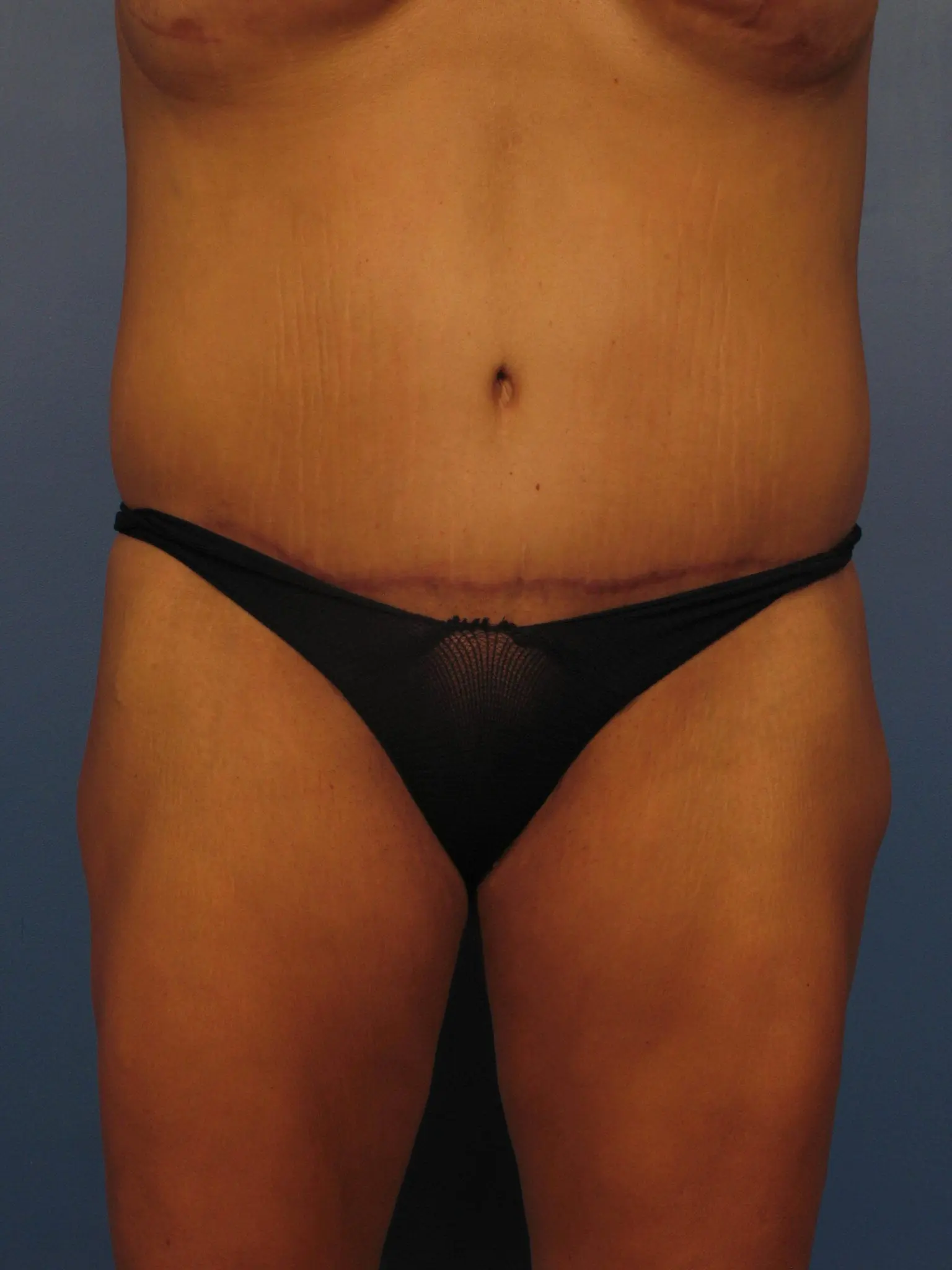 Tummy Tuck Scars Before and After Photo Gallery